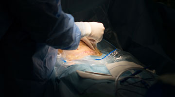 C-section procedure